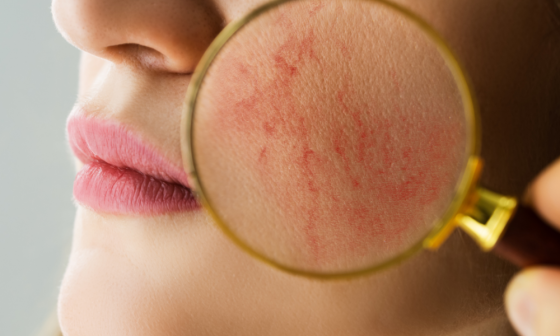 Rosacea Triggers to Avoid for Clear Skin