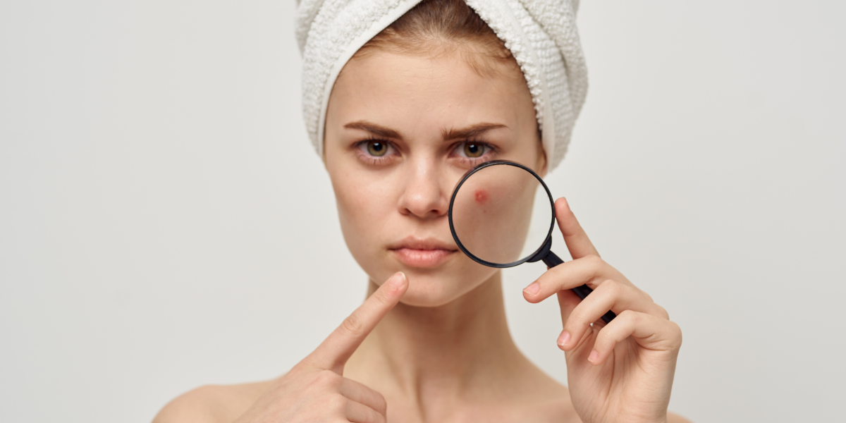 Why Oily Skin Causes Acne - And What You Can Do About It