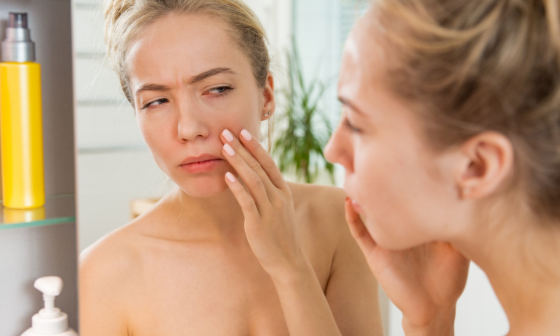 The Best Moisturisers for Acne-Prone Skin